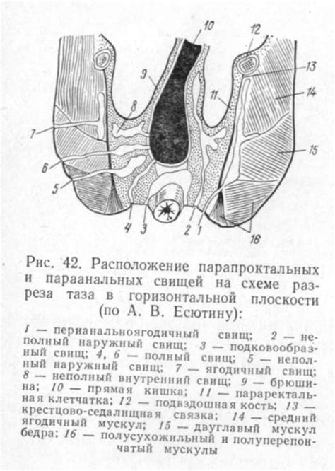 Что такое параректальные свищи?