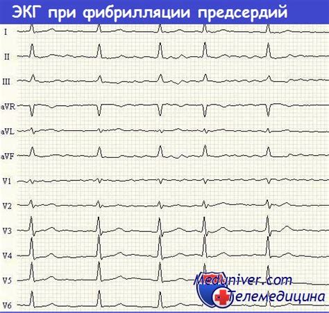 Что такое пароксизмальная форма фибрилляции предсердий