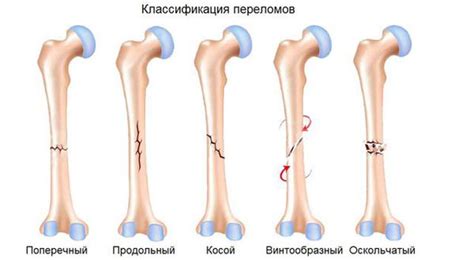 Что такое перелом ноги?