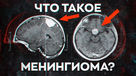 Что такое переходная менингиома?