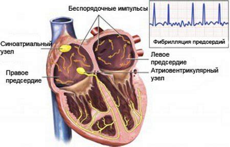 Что такое персистирующая форма фибрилляции предсердий?