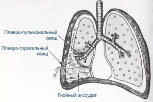 Что такое плевропульмональные тяжи легких