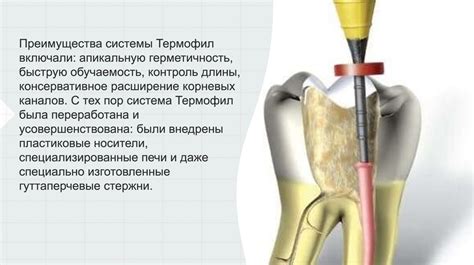 Что такое пломбирование корневого канала?