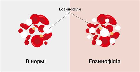 Что такое повышение эозинофилов у женщины?