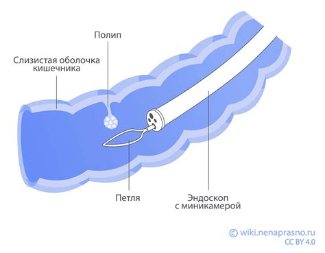 Что такое полипы кишечника