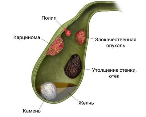 Что такое полип желчного пузыря?