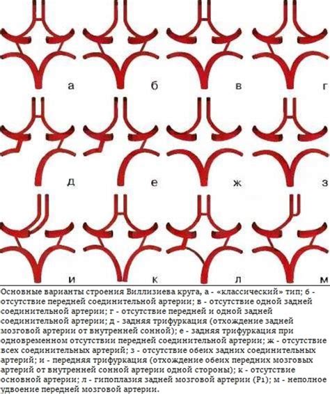 Что такое полная задняя трифуркация левой внутренней сонной артерии?