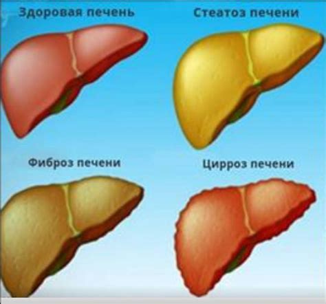 Что такое портальный цирроз?