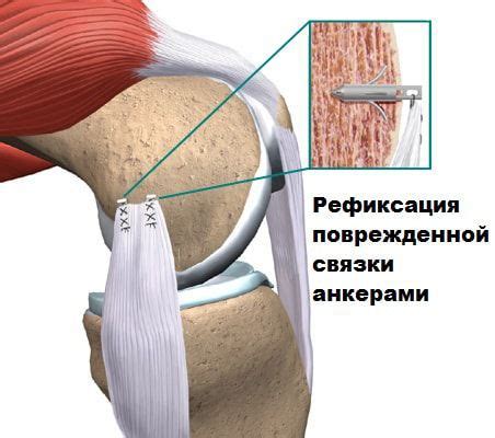 Что такое привычный вывих плеча?