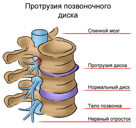 Что такое протрузия межпозвоночных дисков?