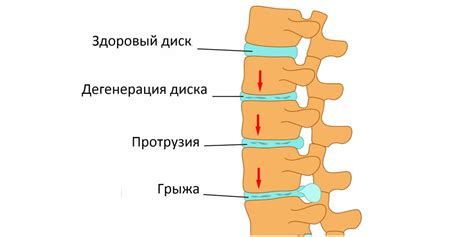 Что такое протрузия позвонка и как ее предотвратить