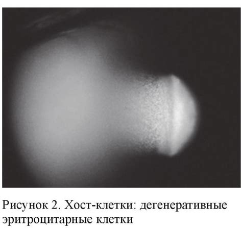 Что такое псевдофакия глаза?