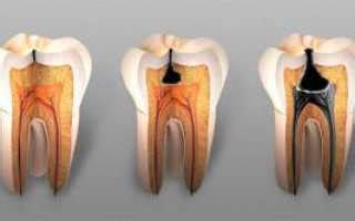 Что такое пульпированный зуб?