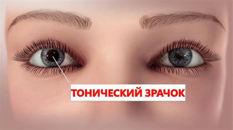 Что такое пульсирующие зрачки