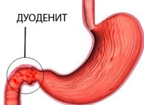 Что такое пустая отрыжка?