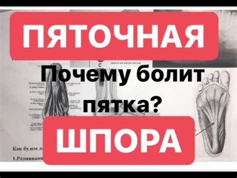 Что такое раздавленная пятка?