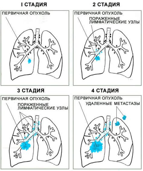 Что такое рак 4 стадии