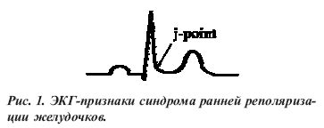 Что такое ранняя реполяризация желудочков?