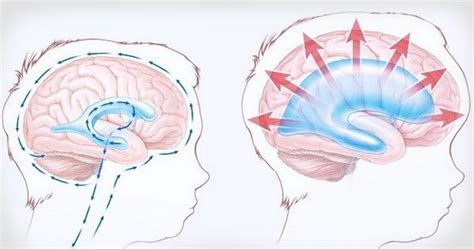 Что такое расширение наружных ликворных пространств мозга у детей?