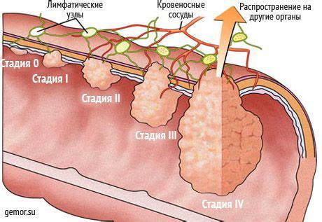 Что такое регионарные метастазы