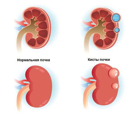 Что такое ретенционная киста почки?