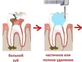 Что такое свищ у зуба?