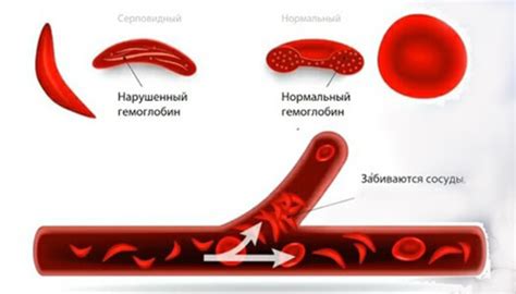 Что такое серповидноклеточная анемия?