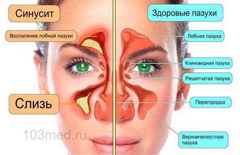 Что такое синусит и его виды