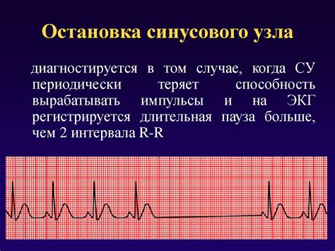 Что такое синусовая аритмия?