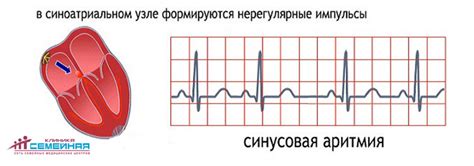 Что такое синусовая аритмия эос горизонтальная?