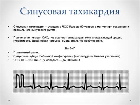 Что такое синусовая тахикардия?