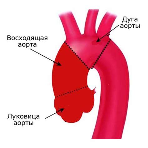 Что такое синусы Вальсальвы?