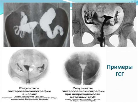 Что такое сканирование маточных труб и почему оно невозможно?