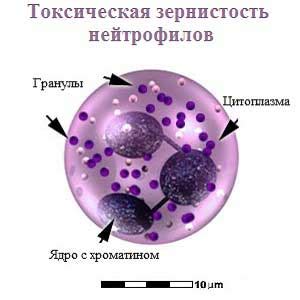 Что такое скопление нейтрофилов?