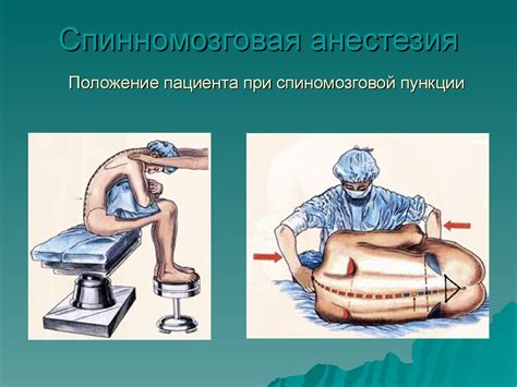 Что такое спинномозговая анестезия?