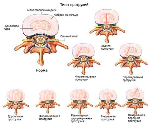 Что такое субартикулярная протрузия диска?