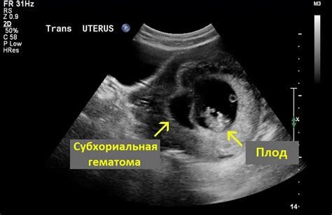 Что такое субхориальная гематома