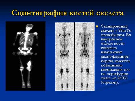 Что такое сцинтиграфия костей: