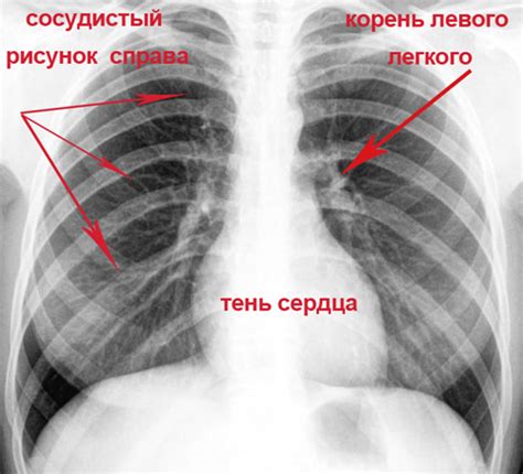 Что такое темные легкие?