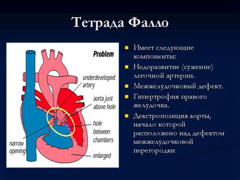 Что такое тетрада Фалло