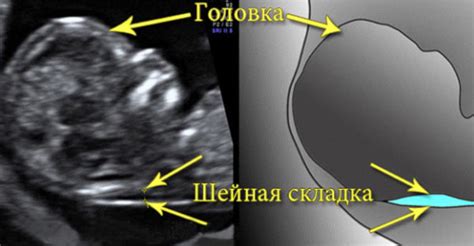 Что такое толщина воротникового пространства?