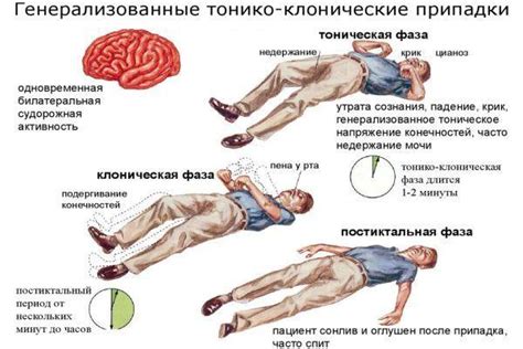 Что такое тонико-клонические судороги?