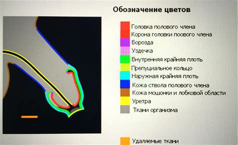 Что такое тугое обрезание