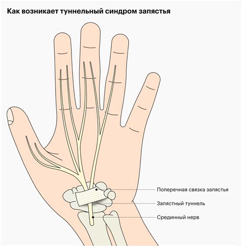 Что такое туннельный синдром ноги