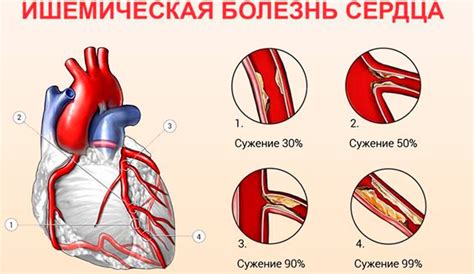 Что такое тупость сердца и почему она опасна для здоровья?