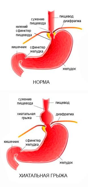 Что такое угол Гиса желудка