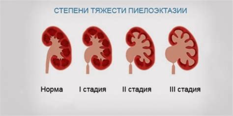 Что такое умеренная пиелоэктазия?