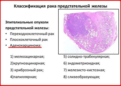 Что такое умеренно дифференцированная аденокарцинома простаты?