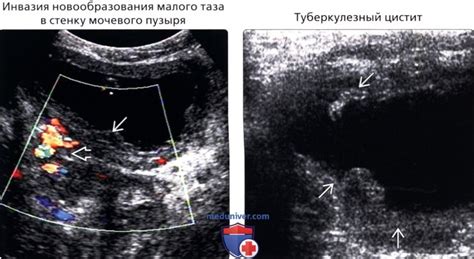 Что такое уплотнение стенки мочевого пузыря?