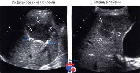 Что такое участок пониженной эхогенности?